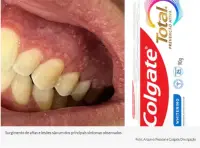 UTILIDADE PÚBLICA Linhas de creme dental da Colgate é interditada pela Anvisa depois que consumidores tiveram lesões bucais
